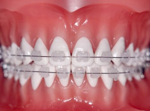 港南台の歯医者、すずき歯科クリニックの矯正歯科