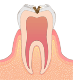 港南台の歯医者、すずき歯科クリニックのむし歯治療