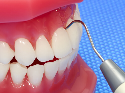 港南台の歯医者、すずき歯科クリニックの予防歯科