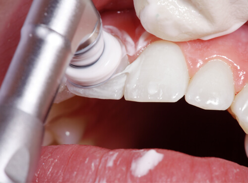 港南台の歯医者、すずき歯科クリニックのむし歯治療