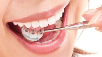 港南台の歯医者、すずき歯科クリニックの舌側矯正