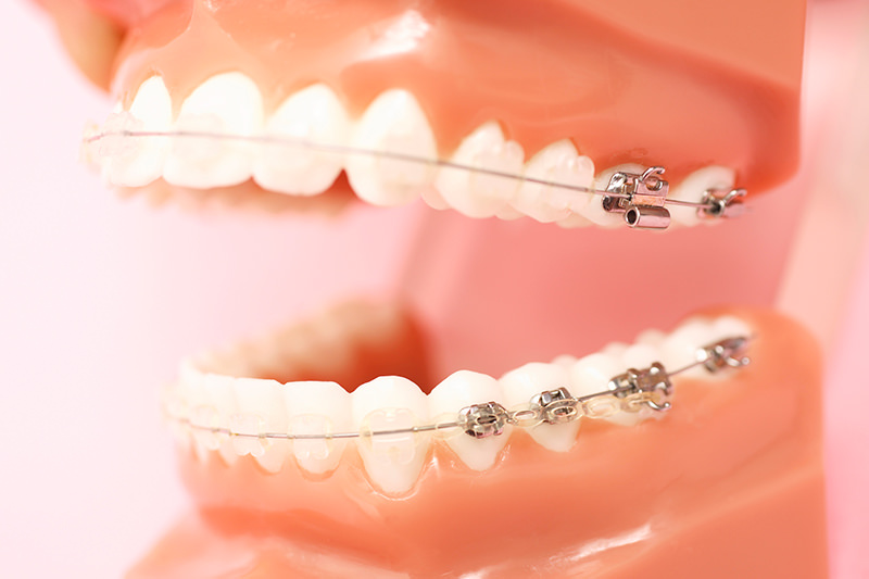 専門ドクターによる矯正歯科 - 港南台の歯医者ならすずき歯科クリニック
